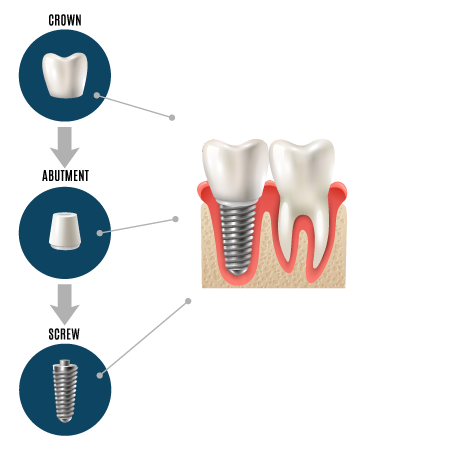 Dental Implants in Merrillville